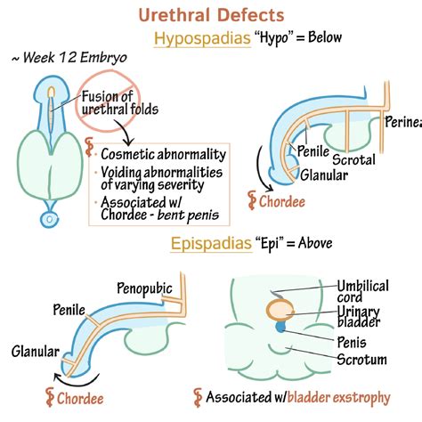 congenital penis abnormalities.